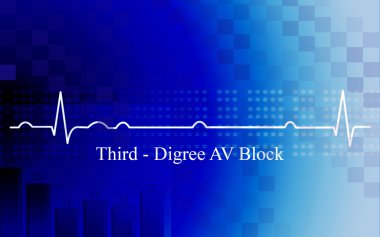 Third degree AV block in coronary diseas clipart