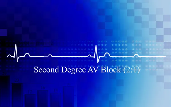 Second degree AV block in coronary disea — Stock Photo, Image