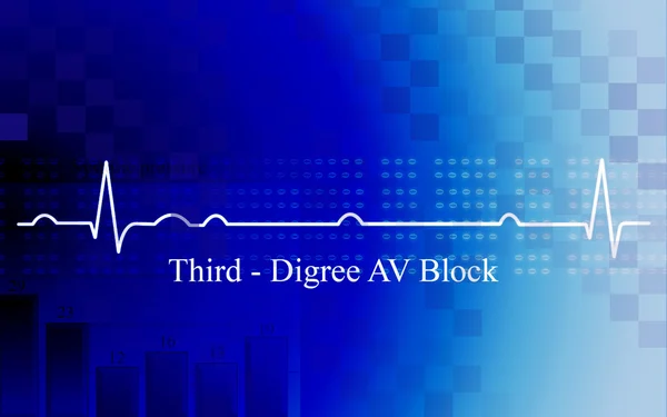 Third degree AV block in coronary diseas — Stock Photo, Image