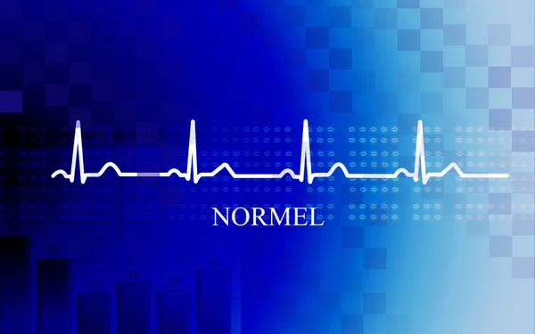 Normal stage AV block in coronary diseas — Stock Photo, Image