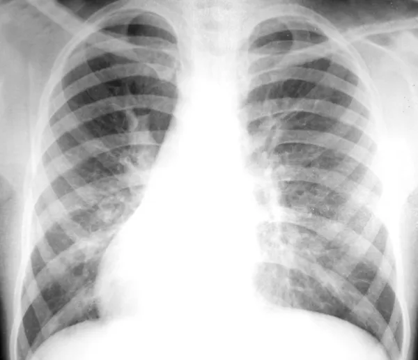 Röntgen der Brust — Stockfoto