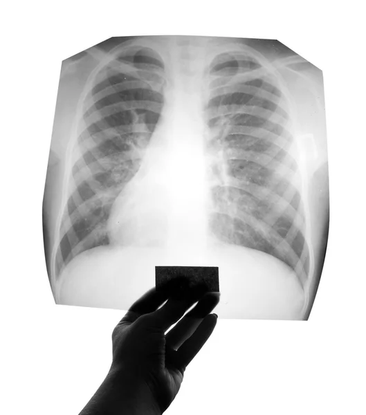Röntgen der Brust — Stockfoto