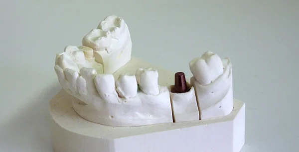 Colocación de implantes dentales —  Fotos de Stock