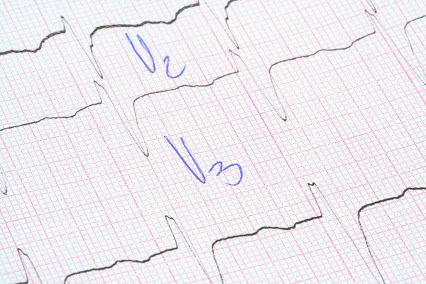 EKG grafiği — Stok fotoğraf