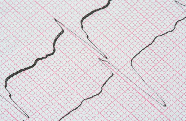 Wykres EKG — Zdjęcie stockowe