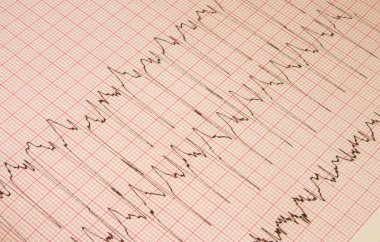 Cardiological test results clipart