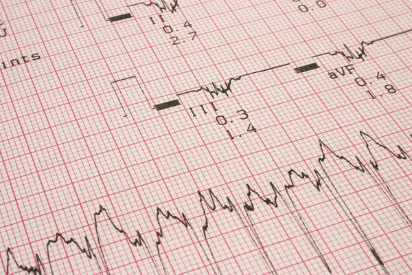 Cardiological test results — Stock Photo, Image