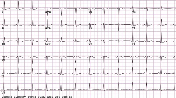 12-lood elektrocardiogram — Stockfoto