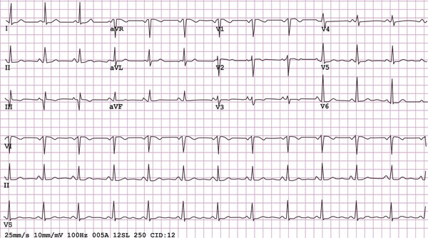 12-lead Electrocardiogram