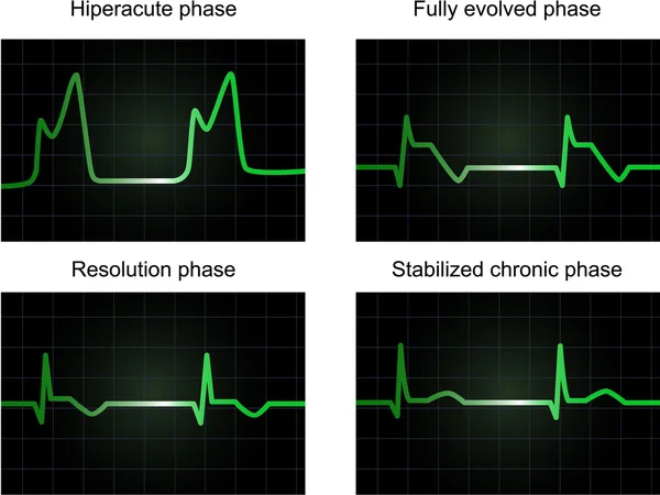 Post miocardial infarct fasen — Stockfoto