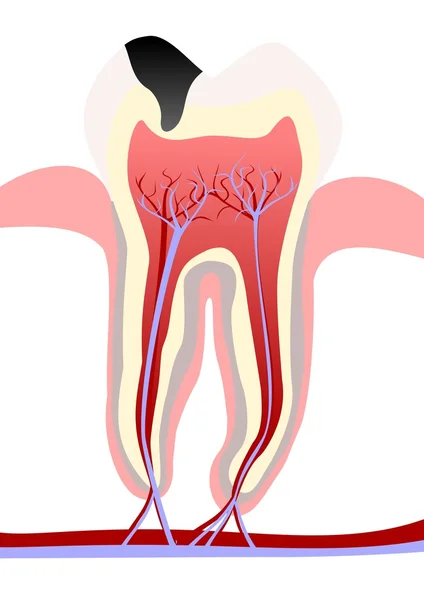 Зубной распад — стоковое фото