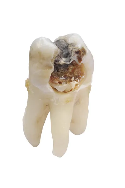Зубной кариес — стоковое фото