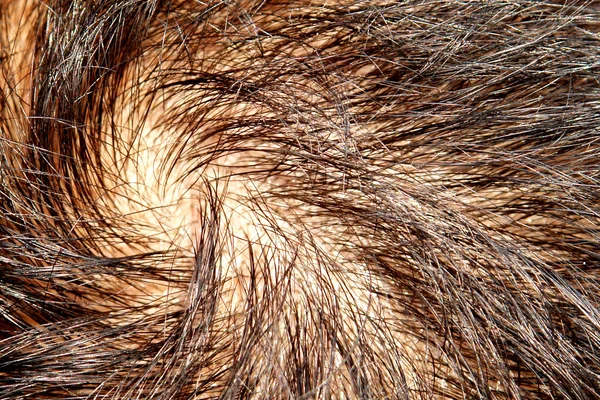 Perda de cabelo — Fotografia de Stock