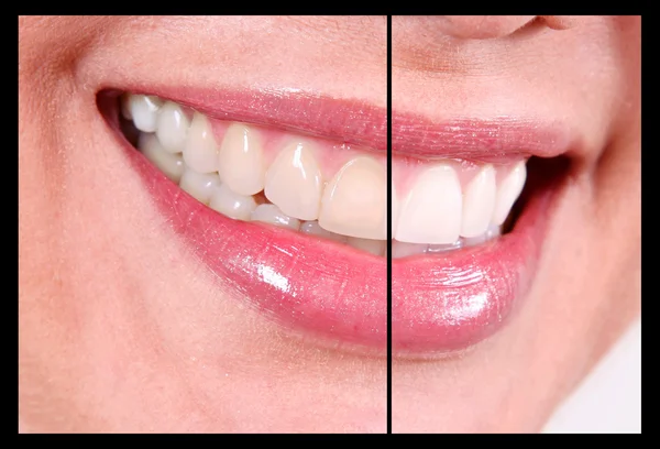 Контрастне Відбілювання Зубів Відбілювання — стокове фото