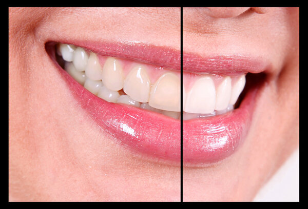 Contrast teeth whitening without bleaching