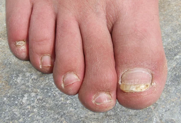 Befallene Fußnägel — Stockfoto