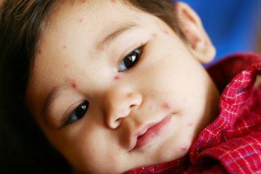 Baby boy with chicken pox clipart