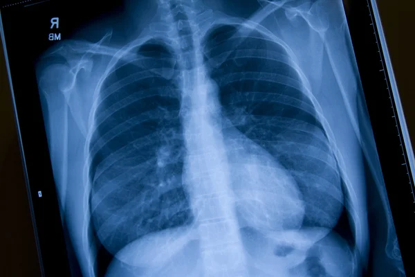 stock image Chest X-Ray