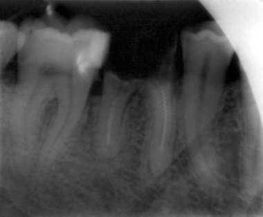 Teeth xray clipart