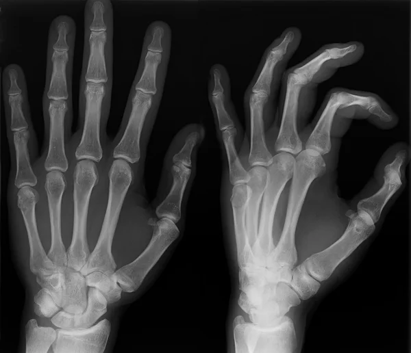 Röntgen der linken Hand. lizenzfreie Stockfotos