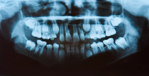 Radiografía dental panorámica. Imágenes de stock libres de derechos