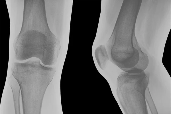 Рентген правого колена . — стоковое фото