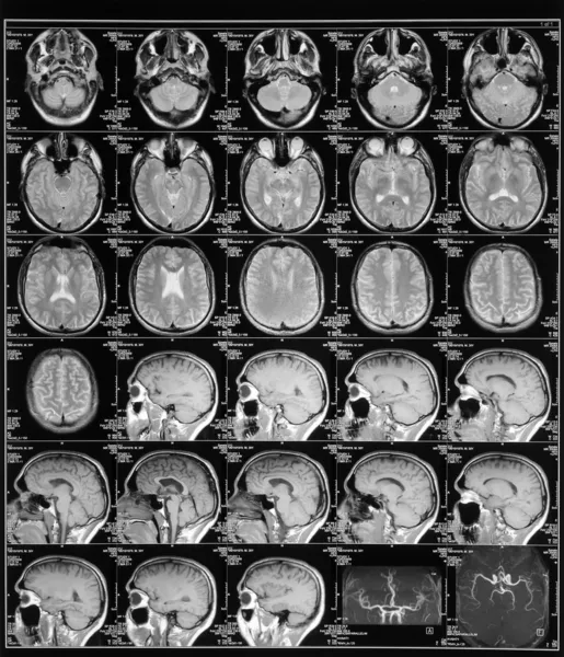 Imagen de resonancia magnética de cabeza —  Fotos de Stock