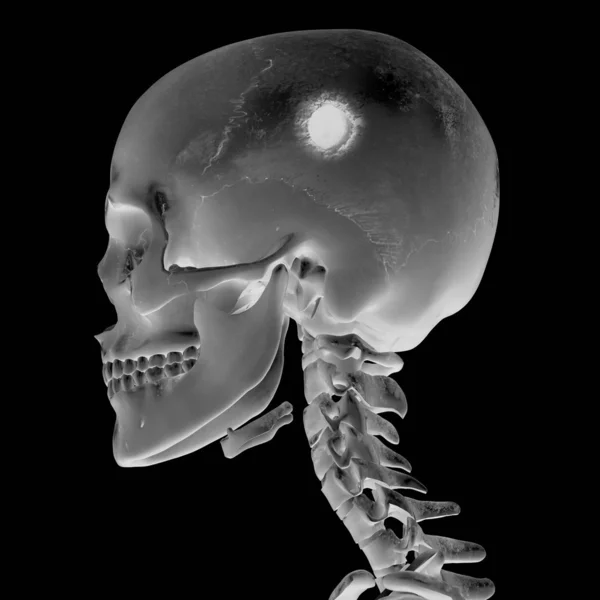3d 射线照相颅脑损伤 — 图库照片