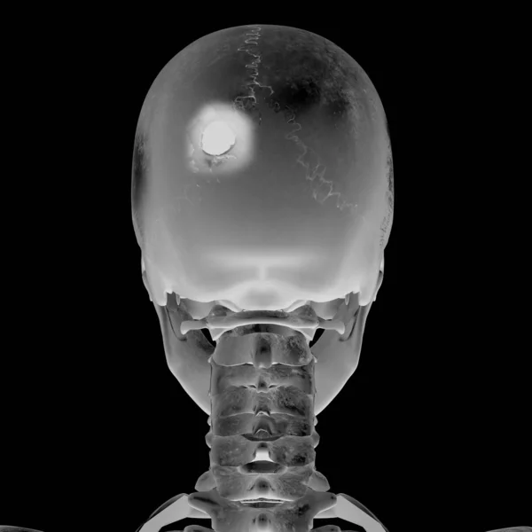 3D röntgenbild med skallskada — Stockfoto