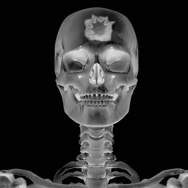 Radiógrafo 3D con lesión en la cabeza — Foto de Stock