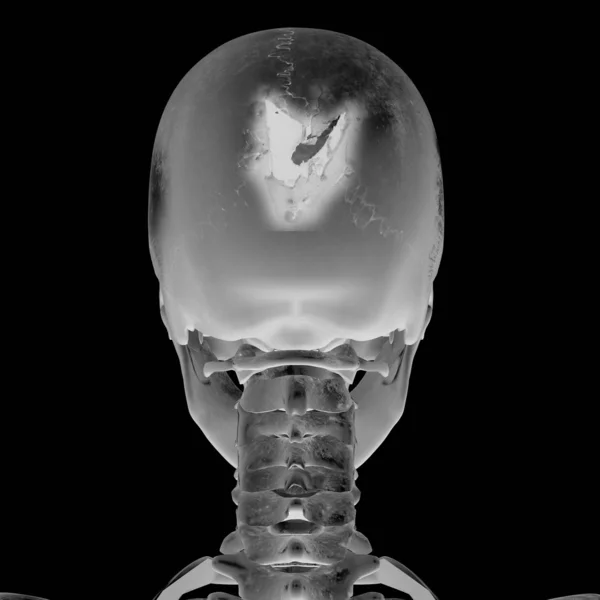3D-röntgenkuva päävamman kanssa — kuvapankkivalokuva