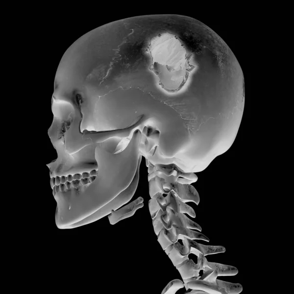 3d 射线照相颅脑损伤 — 图库照片
