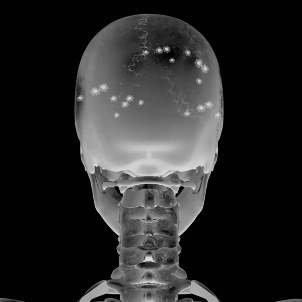 3D-röntgenkuva päävamman kanssa — kuvapankkivalokuva