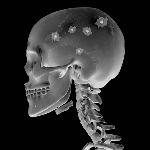 3D Radiograph with head injury — Stock Photo, Image