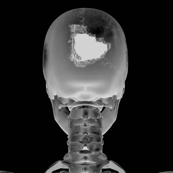 Kafa yaralanması ile 3D grafisi — Stok fotoğraf
