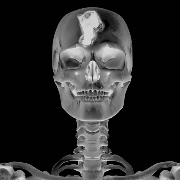 3D Radiograph with head injury — Stock Photo, Image