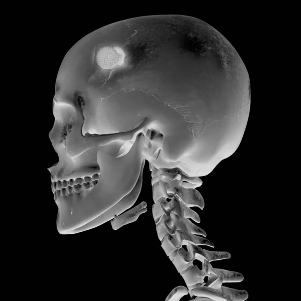 Radiografia 3D con ferita alla testa — Foto Stock