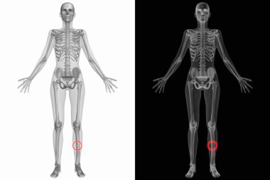 kırık kemik ile insan anatomisi