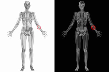 kırık kemik ile insan anatomisi