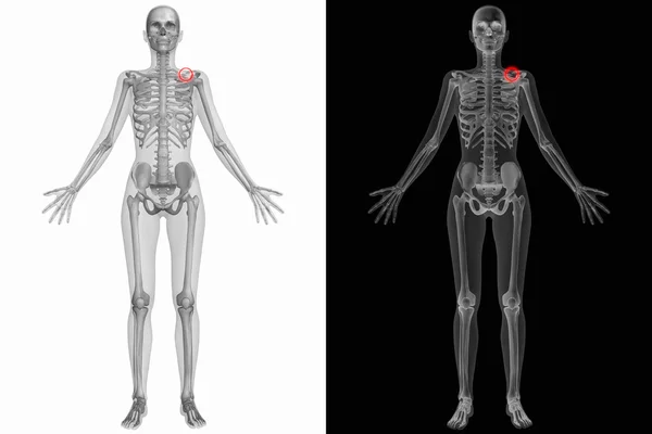 Анатомия человека со сломанной костью — стоковое фото