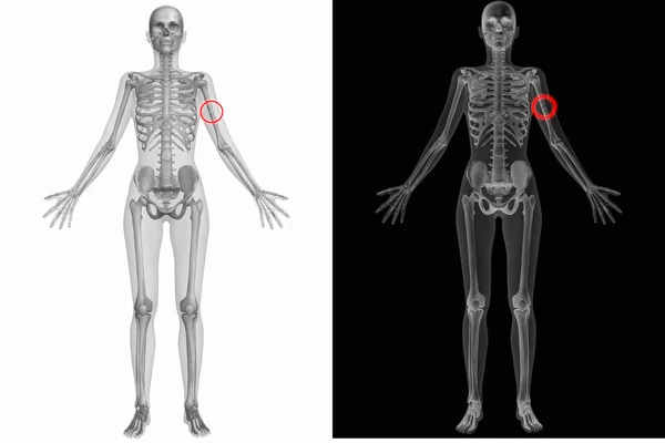 人体解剖学与断骨 — 图库照片