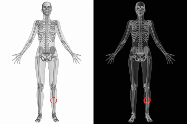 Anatomia umana con osso rotto — Foto Stock