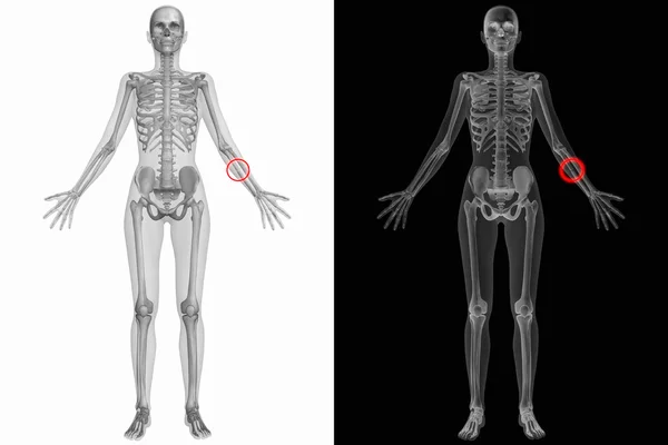 Människans anatomi med brutet ben — Stockfoto