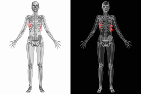 Anatomía humana con hueso roto — Foto de Stock