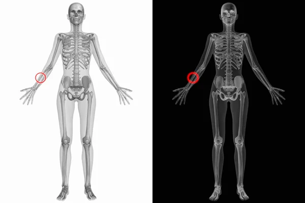 Lidské anatomie s zlomenou kost — Stock fotografie