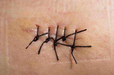 Close-up picture of a scar with stitch clipart