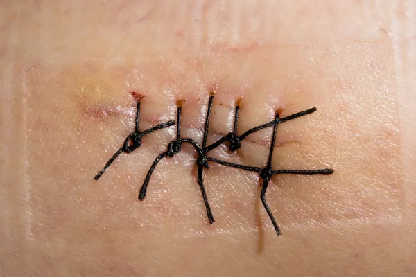Imagen Cerca Una Cicatriz Con Puntada —  Fotos de Stock