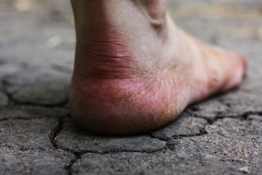 Human foot with cracks clipart