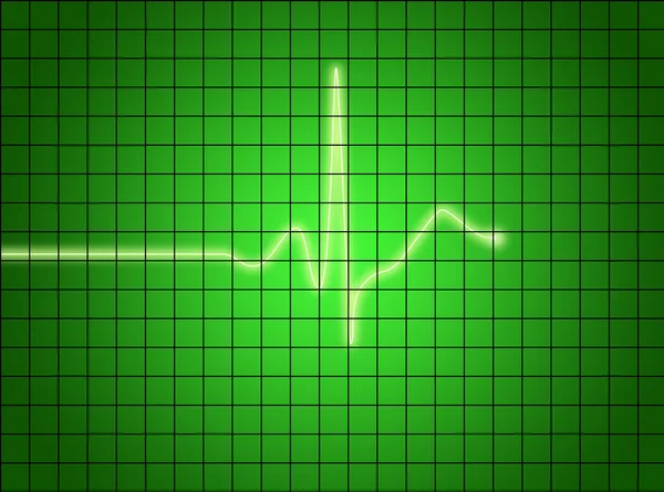 EKG signál — Stock fotografie
