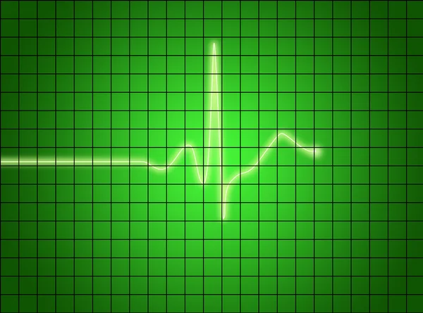 EKG sinyal — Stok fotoğraf